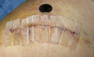 hip_incision_four_days_later.jpg